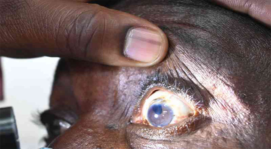 red eye disease spreads in Busia