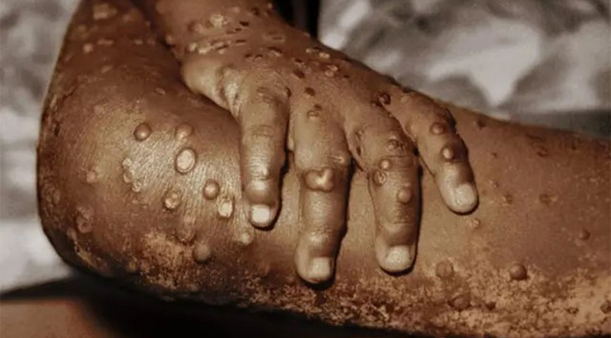 Ministry Of Health Confirms 9th Mpox Case In Nakuru